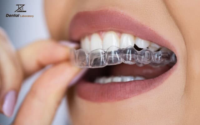 Clear aligners can be custom-made in a dental lab