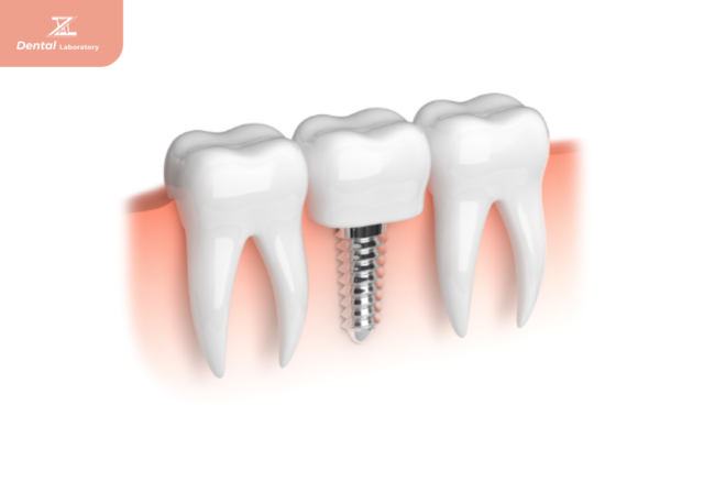 Implant Teeth Supplier Company