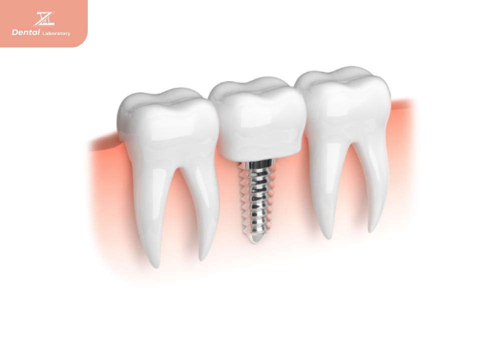 WHAT ARE DENTAL IMPLANTS?