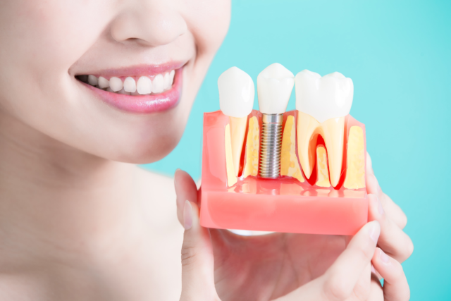 Implant teeth supplier company