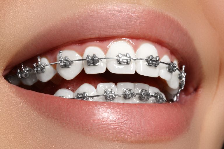 WHAT IS ORTHODONTIC?